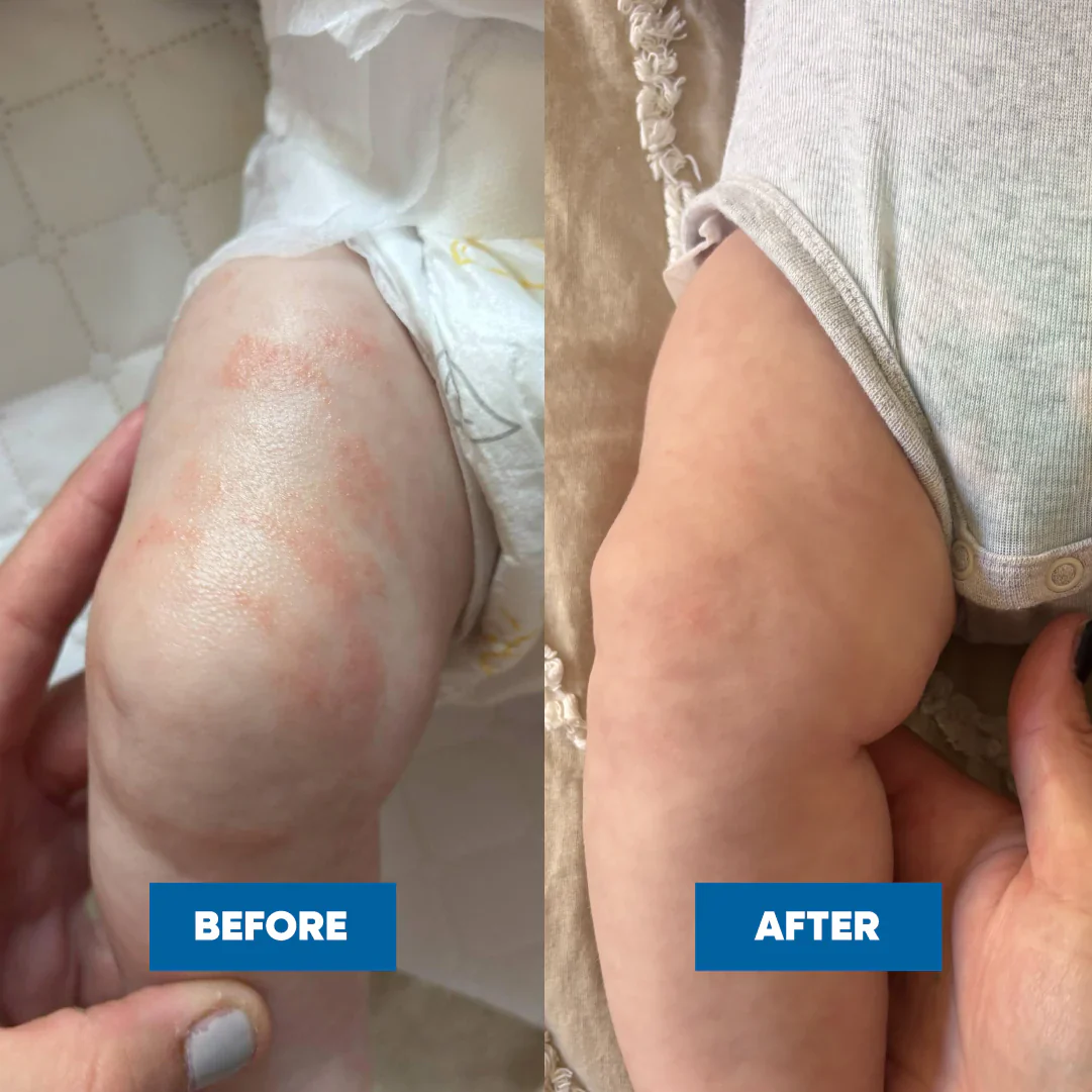 MooGoo Pink Eczema Cream 120g - Image 6
