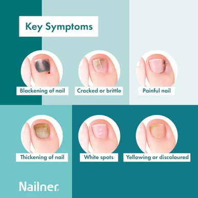 Nailner Fungal Nail Brush 5ml - Image 3